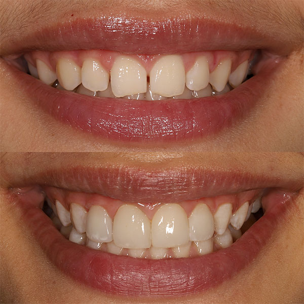 Composite Veneers: before and after results in the clinic Birch Dentistry. Issaquah, WA .
