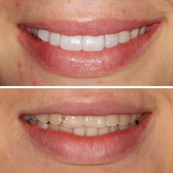 Composite Veneers: before and after results in the clinic Birch Dentistry. Issaquah, WA 
