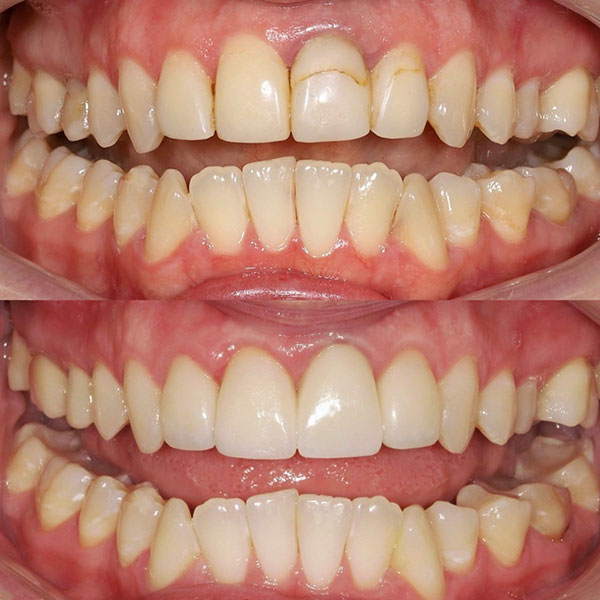 Crowns: before and after results in the clinic Birch Dentistry. Issaquah, WA 