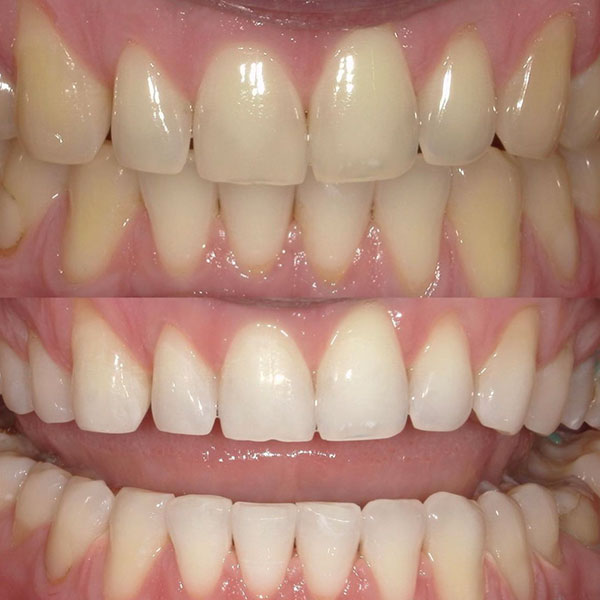 Teeth Whitening: before and after results in the clinic Birch Dentistry. Issaquah, WA 