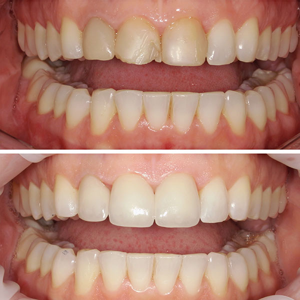Porcelain Crowns: before and after results in the clinic Birch Dentistry. Issaquah, WA.